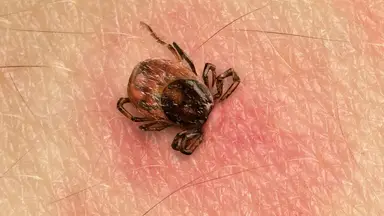 Paralysis Tick bite causing an allergic reaction