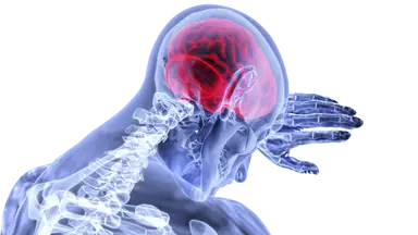 Illustration of Stroke showing brain inflammation