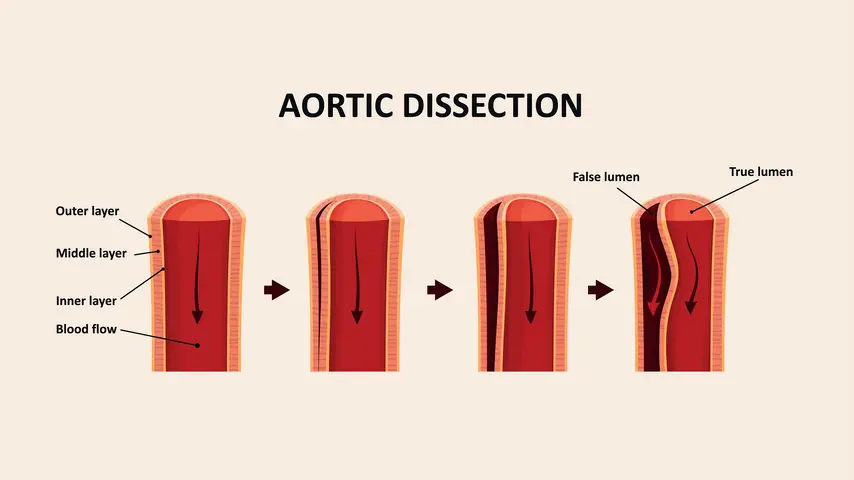 Aortic Catastrophe