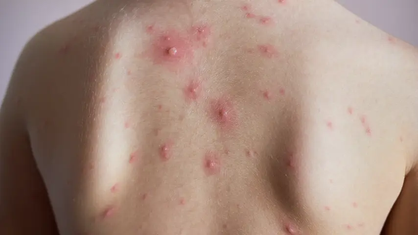 Chicken pox blister on back of a child
