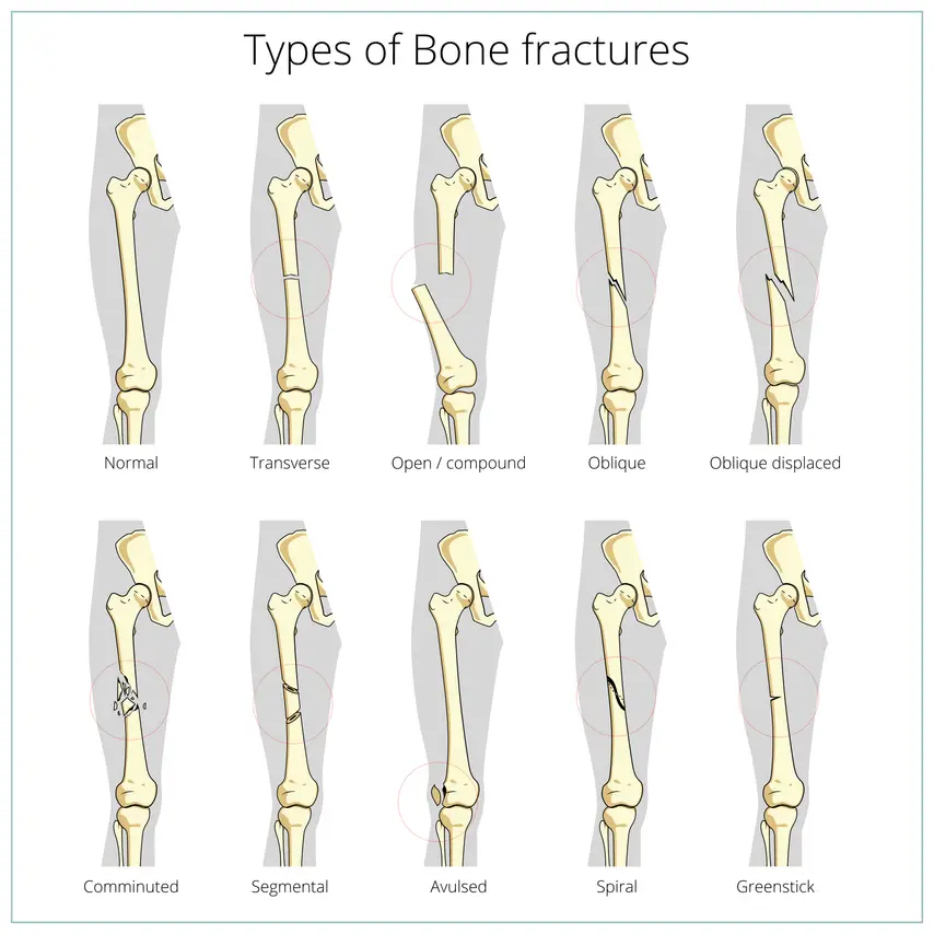 Illustrated types of bone fractures