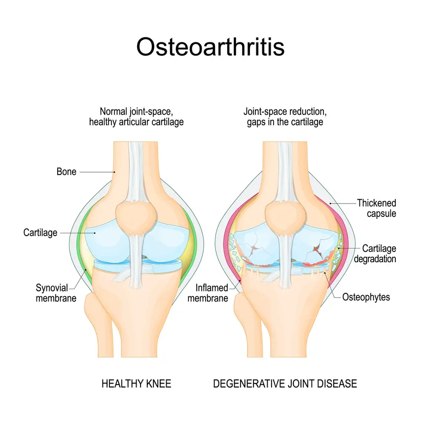 Osteoarthritis in the knee