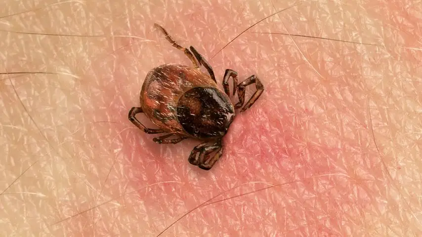 Paralysis Tick bite causing an allergic reaction
