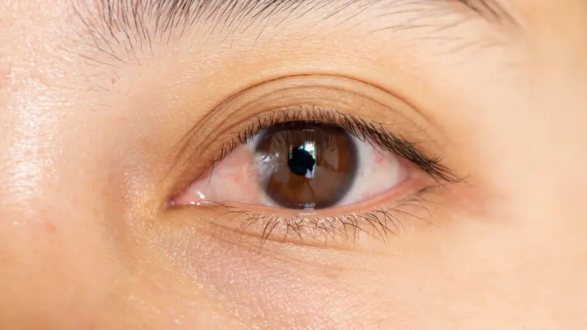 pterygium photo