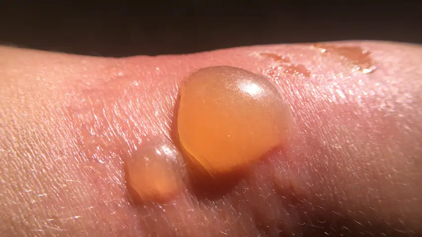 Sunburn blister
